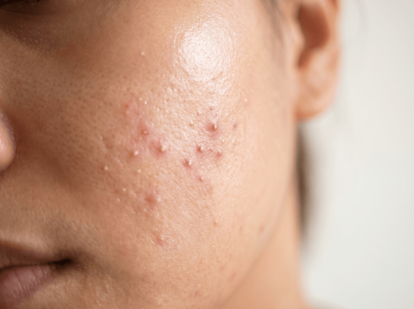 Acne & Breakouts